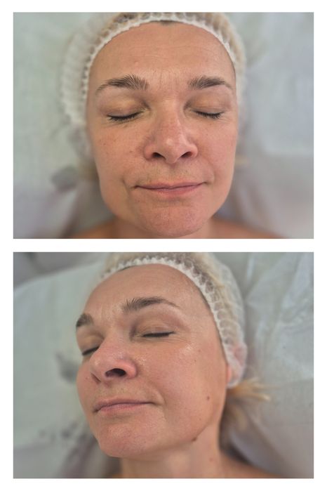 Kosmetyczne Peeling kwasowy