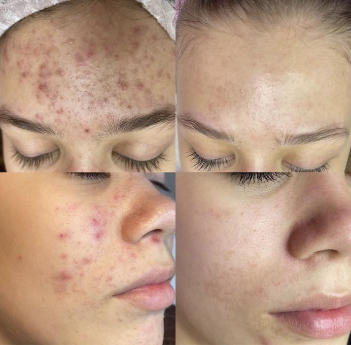 Лікування акне крем Obagi Tretinoin Cream
