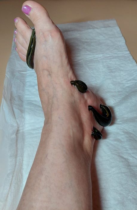 Гирудотерапия, пиявки,  хиджама