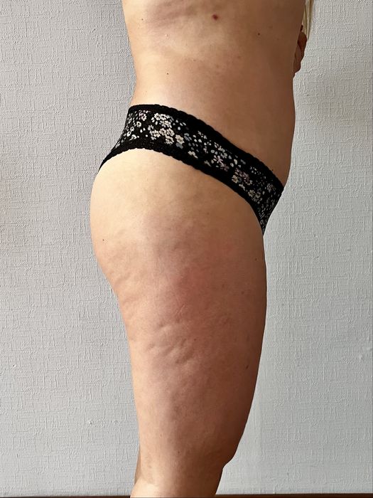 Антицелюлітний масаж