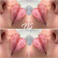 Medycyna estetyczna - Powiększanie ust wolumetria botoks lipoliza