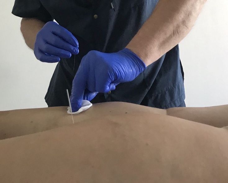 Массаж. Иглотерапия / Акупунктура. Медицинский плазмолифтинг