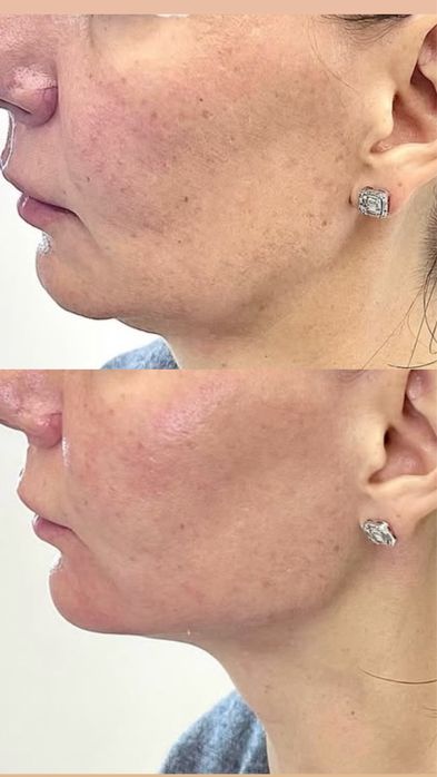 Косметолог Контурная пластика Славянск