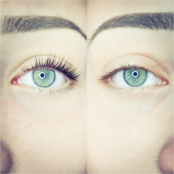 Stymulatory Biorewitalizatory Dermapen Mezoterapia Btx effect