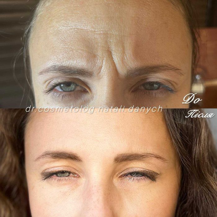 Косметолог. Инъекции красоты . Ботокс - 10%. Левобережная