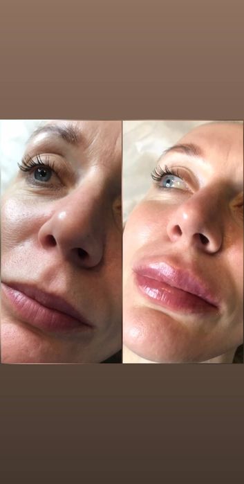 Косметолог Київ, Працюю!!  Акція Ботокс 2500 3 зони.