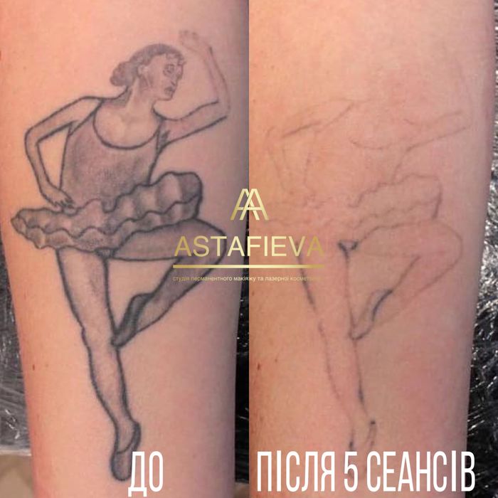 Скидка на безопасное Лазерное удаление тату/татуажа карбоновый пилинг