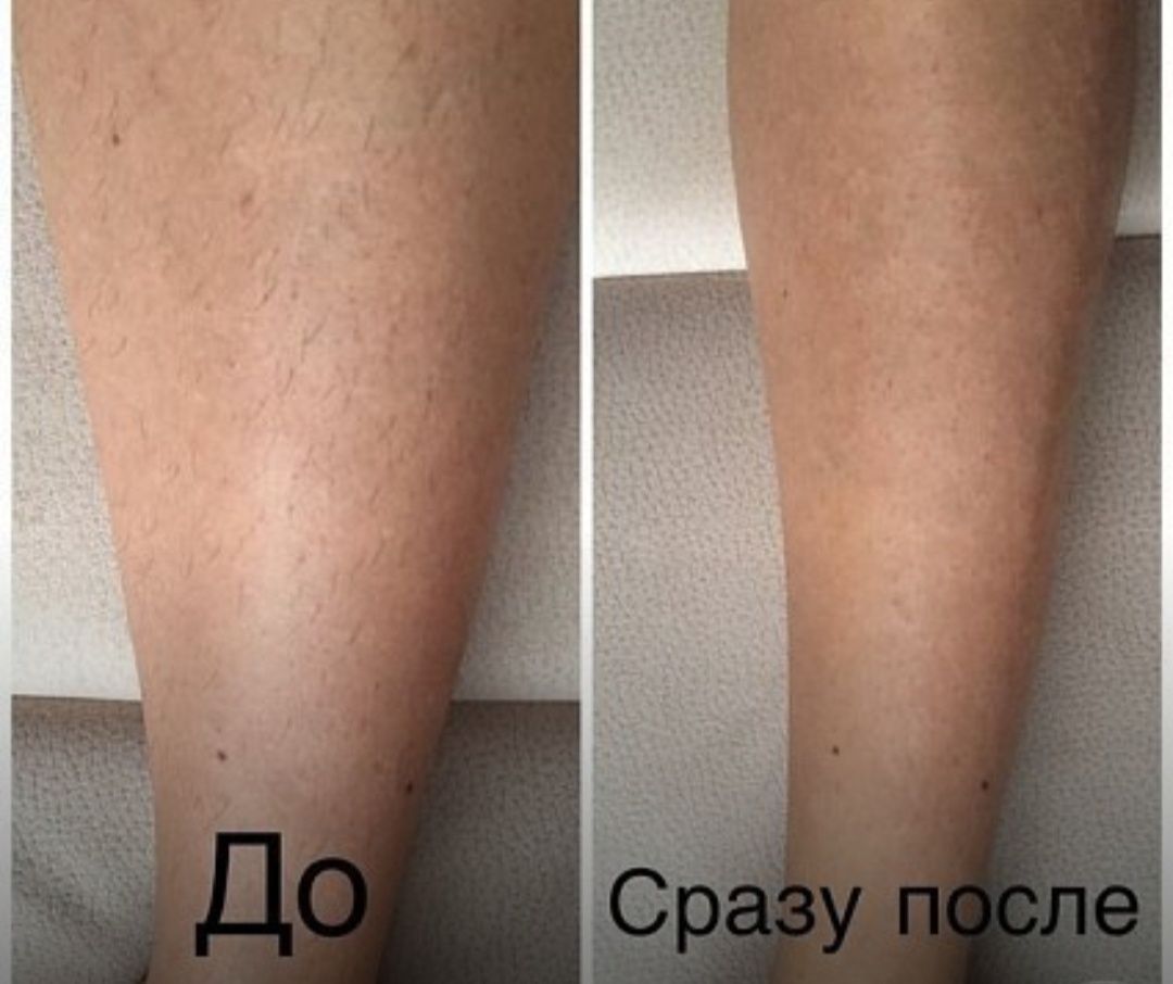 Електроепіляція на Виноградарі