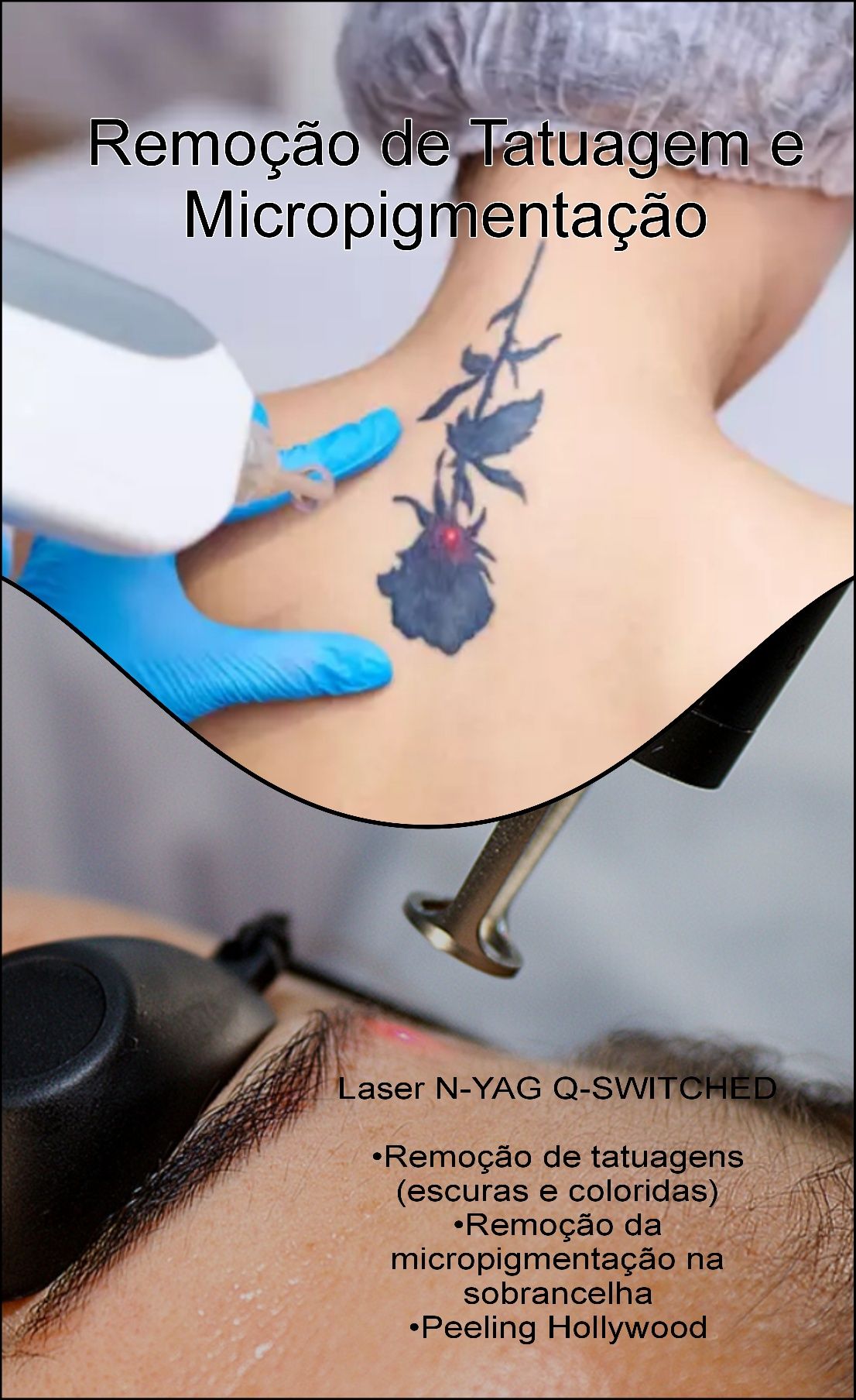 Depilação e remoção de tatuagens a laser
