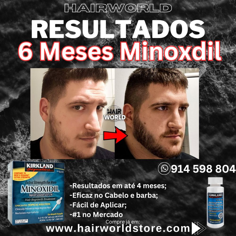 Minoxidil Resultados em ate 4 meses *