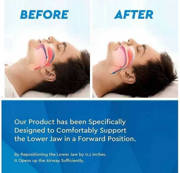 Wkładka doustna na zęby NEOMEN Chrapanie Zgrzytanie zębami Bruksizm