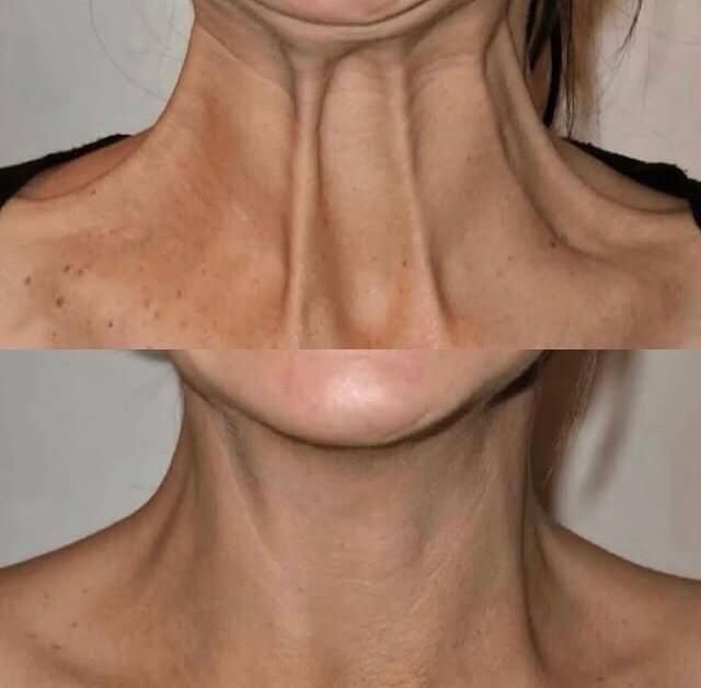 Ботокс. Коррекция морщин,всё зоны, Фулфейс.