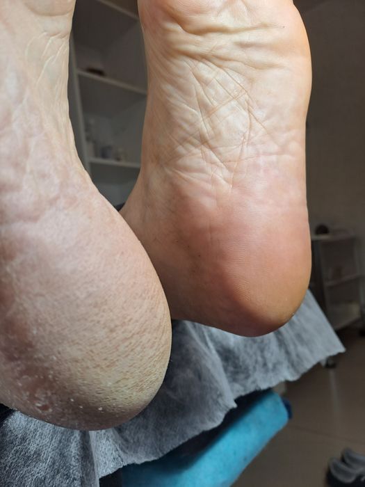 Апаратний педикюр з основами подології в місті СУМИ