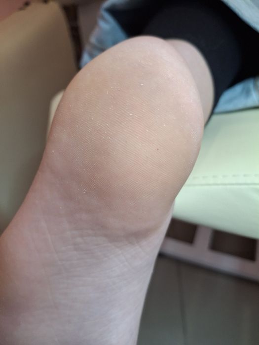 Медичний педикюр