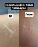 Удаление шрамов, растяжек. Камуфляж под цвет кожи.Николаев