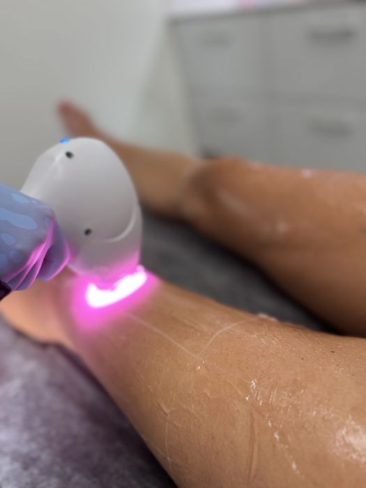 Laser do depilacji Primelease wynajem