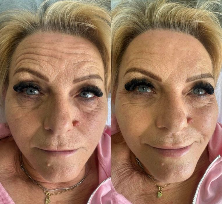 Botox Najniższa cena Botoks 150zł za 1 okolicę na zmarszczki botulina