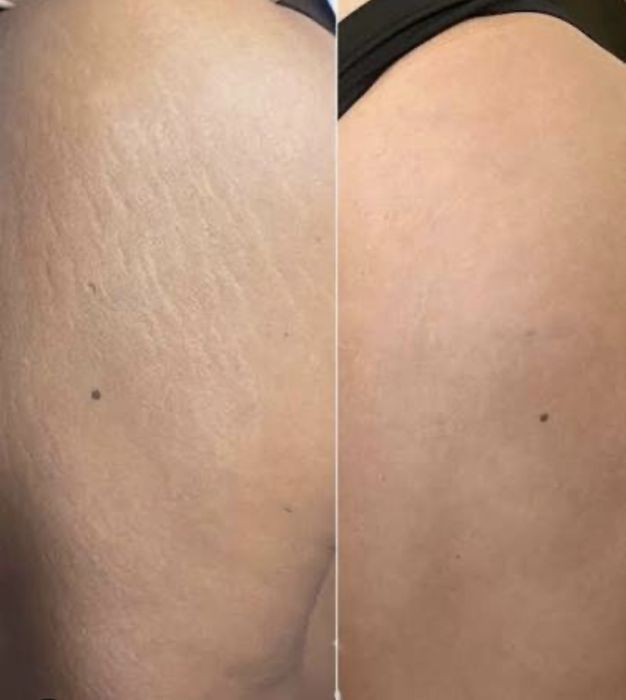 Мікроліндінг-Видалення шрамів-Рубці-Розтяжки