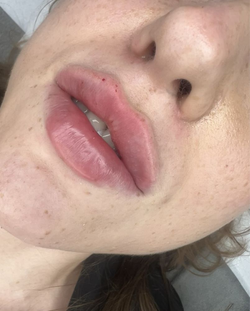 Powiększanie ust, botox , wolumetria, endermologia WARSZAWA 250 zł