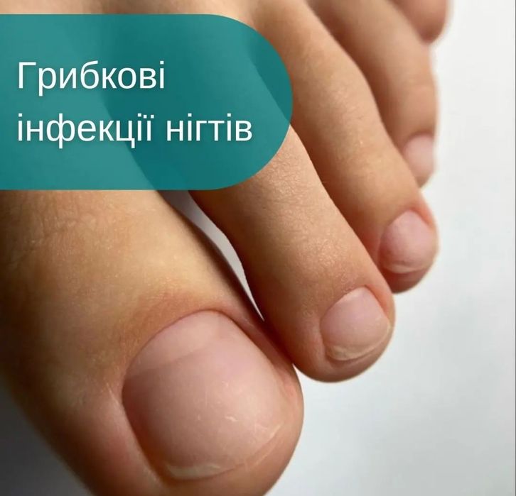 Лікування грибка нігтів
