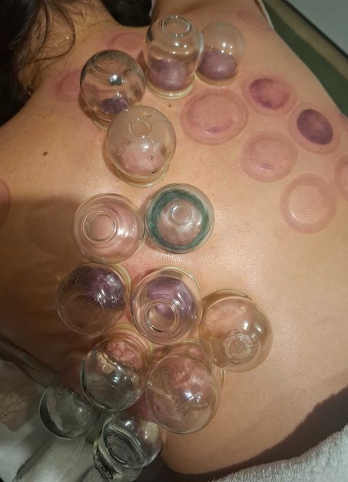 Terapie bańkami ogniowymi i bezogniowymi.