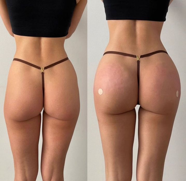 Ботокс, мезонити, увеличение губ,ягодиц