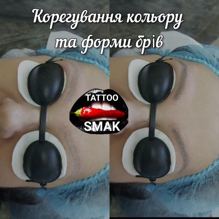 Лазерне видалення тату та ПМ