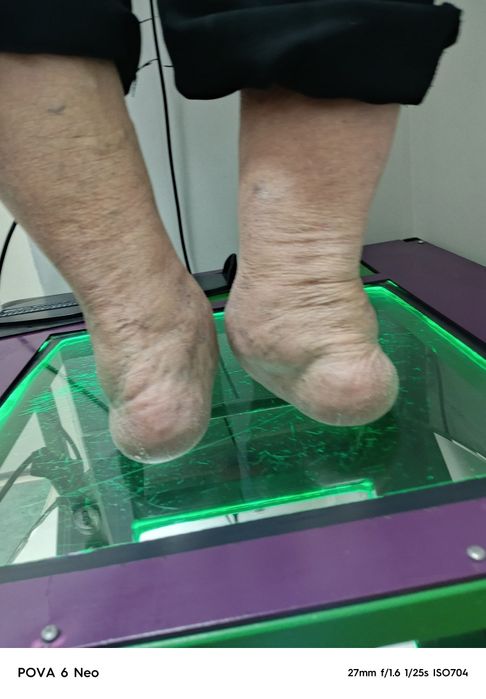 Ортопедичні устілки індивідуального виготовлення