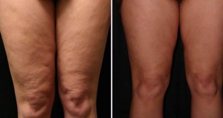 Massagem modeladora Radiofrequência