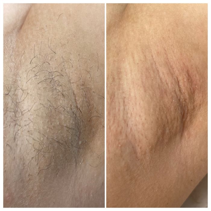 Электроэпиляция Одесса. Пос. Котовского.Удаление волос навсегда!