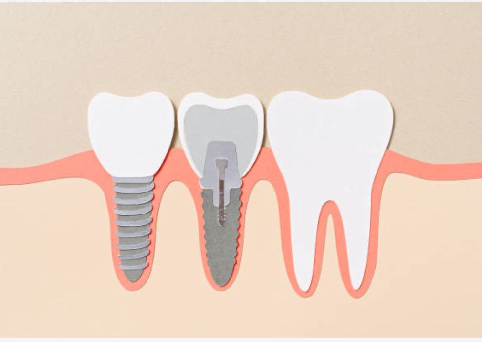 Implante dentario e coroa