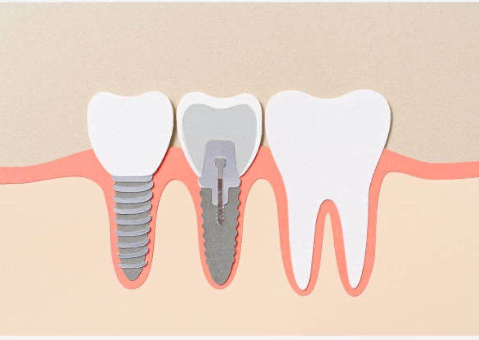 Implante dentario (450€)
