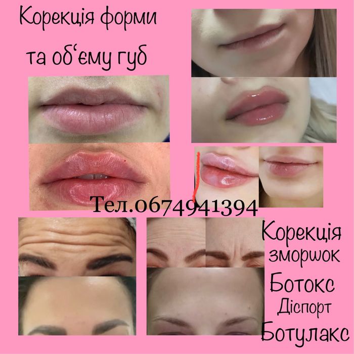 Послуги косметолога збільшення губ Ботокс Диспорт