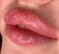 Контурна пластика губ, збільшення губ