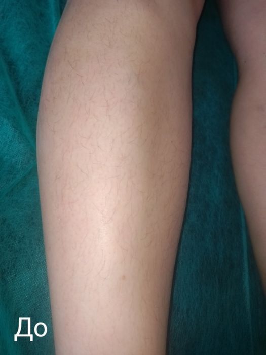 Депіляція видалення небажаного волосся