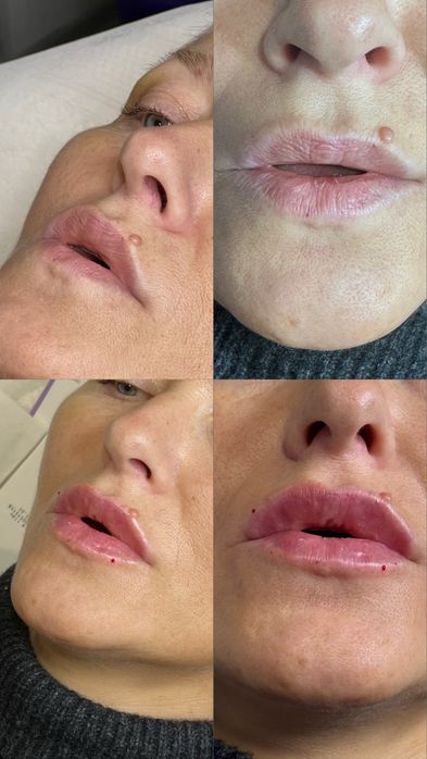 Шукаю моделей на контурну пластику губ,препарати тільки сертифіковані