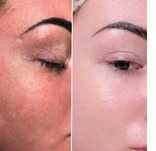 Dermapen domowy Dr Pen