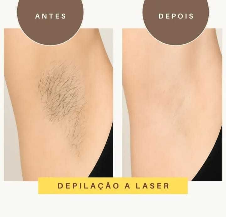 Depilação a laser, remoçao de tatuagem e peeling com valor justo