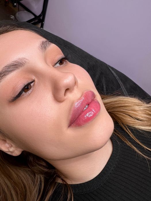 Збільшення губ та контурна пластика