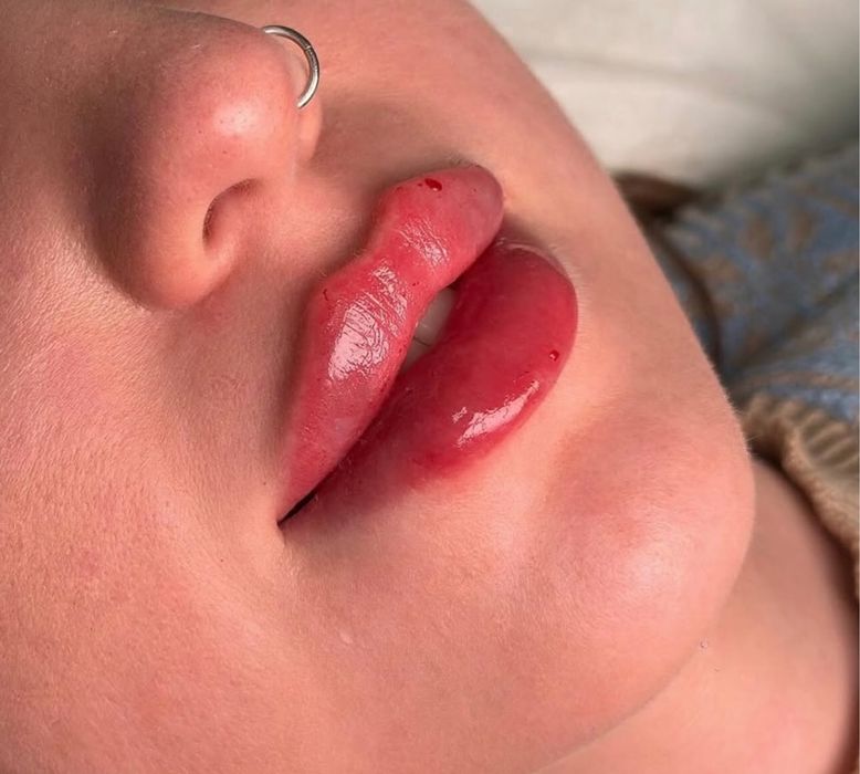 Акція на всю контурну пластику обличчя. Збільшення губ, ботокс, біо