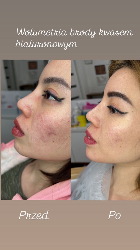Powiększanie ust, botox , wolumetria, endermologia WARSZAWA 250 zł