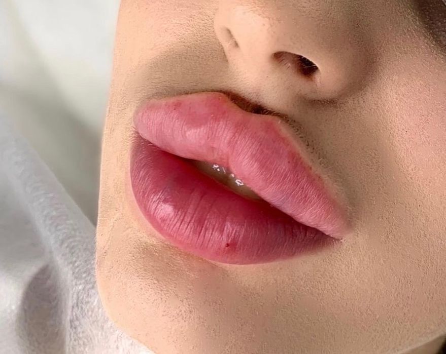 Увеличение губ, ботокс