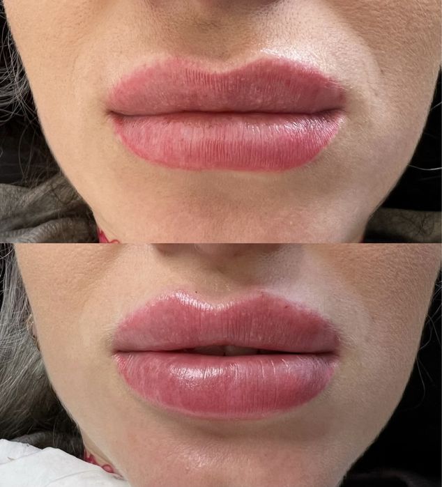 Super Promocja 450zł Modelowanie powiększanie ust wyrównanie asymetrii