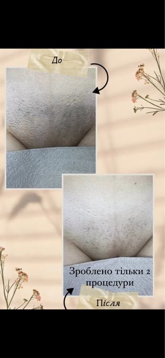 Лазерная эпиляция