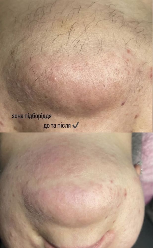 Електроепіляція-видалення небажаного волосся назавжди