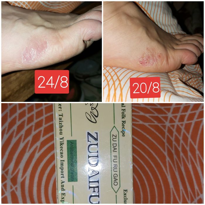 Vendo pomadas para vários  problemas  de pele