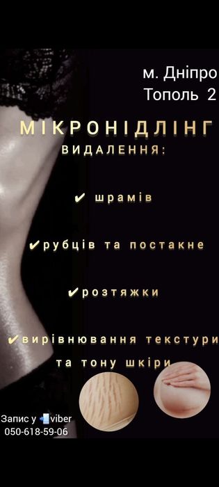 МІКРОНІДЛІНГ ВИДАЛЕННЯ Растяжек/Рубців/Шрамів/Татуажу/Дніпро /ТОПОЛЬ 2