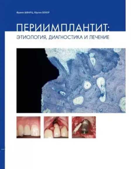 Периимлантит, этилогия, диагностика и лечение, Ф Шварц 2014 стомато