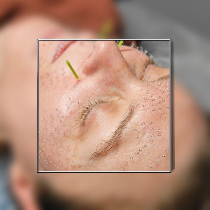 Naturalna Medycyna Estetyczna - akupunkura, masaże twarzy