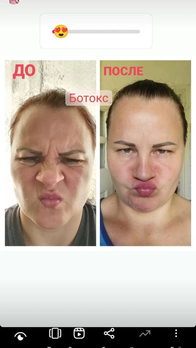 Косметолог- Дерматолог.Ботокс.Контурная пластика. Чистка лица. Массаж